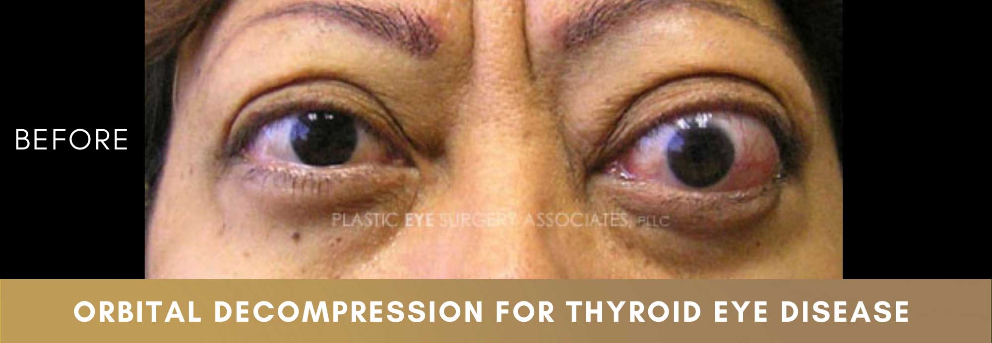 Thyroid Eye Disease   Plastic Eye Surgery Associates